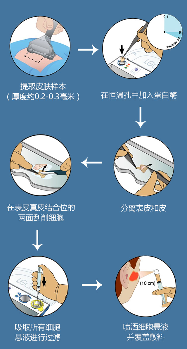 器技术,外科医生在30分钟内,就能有效地使用患者自身的细胞治疗疤痕